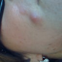 starting to abcess and drain
