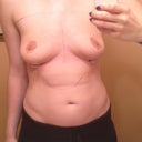 After Surgery- Day 1. Hello beautiful saggy boobs! :)