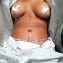 48 hrs post op