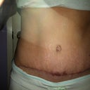 My scar at 3.5 months PO