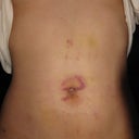 5 DAY POST-OP: Bruised and swollen
