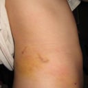 5 DAY POST-OP: Side view