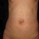 8 DAY POST-OP: much less bruising, swelling is going down a bit