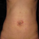 9 DAY POST-OP: Wooot! Are those the beginnings of some upper abs I see?