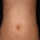 11 DAY POST-OP: Bruises are barely there!