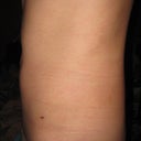 11 DAY POST-OP:: Side view.not too shabby!