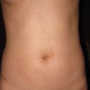 11 DAY POST-OP: Front View