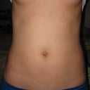 3 WEEKS POST-OP: Front...incision scars are hanging around, but definitely on their way out.