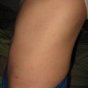 3 WEEK POST-OP: Side view
