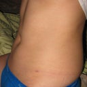 3 WEEK POST-OP: Sitting, profile...still some rolls--I hope it's just swelling and not fat rolls!