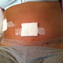 2 weeks post op