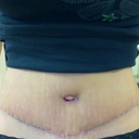 Progress............. I am so happy with my scars. 3 weeks post op