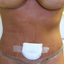 I am shaped weird. I wanted the lipo to contour my shape. But it was not done.