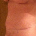 Left side at 13 weeks