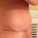 Right side at 13 weeks