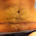 3 Weeks PostOp