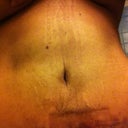 4 Weeks Post Op again!!!