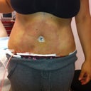 Right after surgery