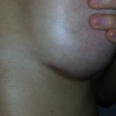 2 month post op