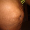 Hernia present!