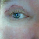 scarring along incision line
