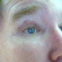 scarring along incision line