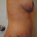 4 weeks post-op