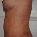 4 weeks post-op