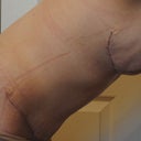 4 weeks post-op