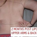 2 months post lipo = worse