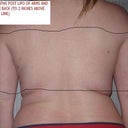 2 months post lipo = worse