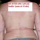 Day after.  Left arm smaller than right (same at 10 wks post)