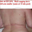 Day after. Can see sagging fat (same at 10 weeks post)