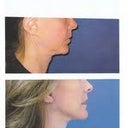 before and after repair of chin, ears and lower face lift