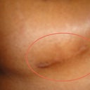 Picture of my scar - left side under breast - nearly a year later.