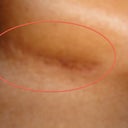 Picture of my scar - right side under breast - nearly a year later.