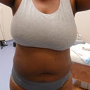 Post Op Day 1 Front