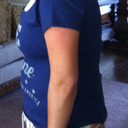 When's my baby due you ask? POST OP DAY 5!!! HUUUUGE!