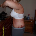 Day after surgery