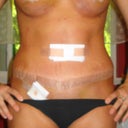 AFTER: ONE WEEK postOp. Still have tape on the incision areas. Quite a bit of swelling...but for 1 week...all and all pretty good. :)