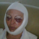 Right after surgery...don't let it scare you. With meds and home care, it passes quickly and it's worth it!!