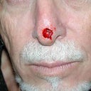 Male Nose Cancer Reconstruction