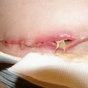 Necrotic tissue death after abdomnioplasy done by Dr. Gallico
