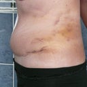 Day 15 PO still very swollen