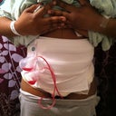 After at home bandage and wrapped up....