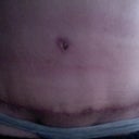 !0 weeks PostOp.  Scar is healing nicely.  It loves to be massaged!  I still have swelling around hip area.