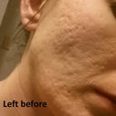 Left Side before