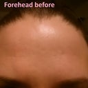 Forehead before