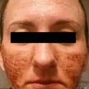 A few hours after (Day 1)
