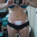 2 days post op and you can see my new shape.  I still have 2 sites that are leaking pretty bad, and I've covered up the other holes to keep them clean.